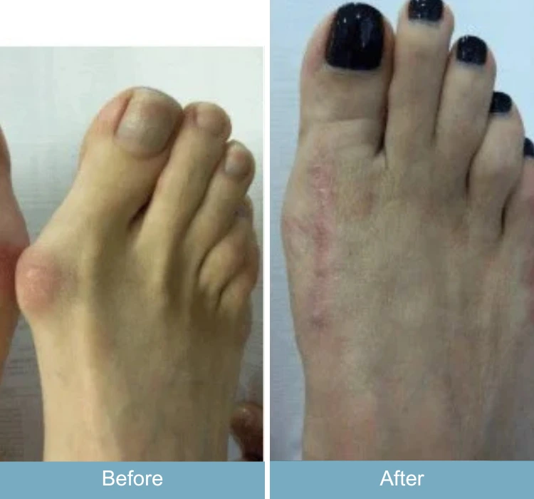 Before and after foot showing reduced bunion prominence and improved foot contour