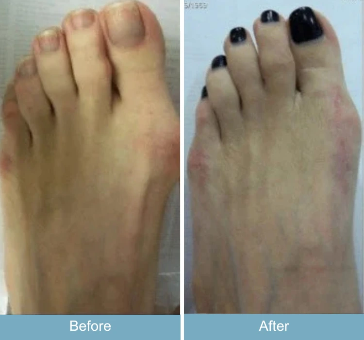 Before and after foot showing corrected bunion with straighter toe positioning
