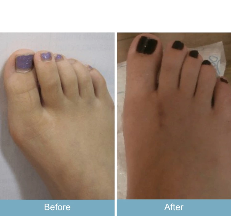 Before and after foot showing bunion reduction and nail treatment