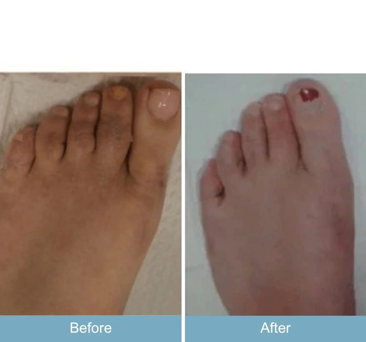 Before and after foot showing bunion and hammertoe correction