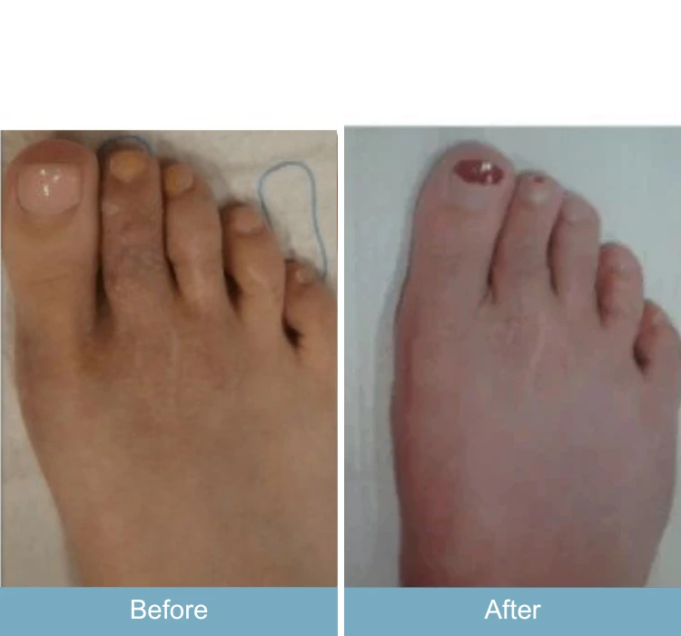Before and after foot showing bunion correction and reduced swelling