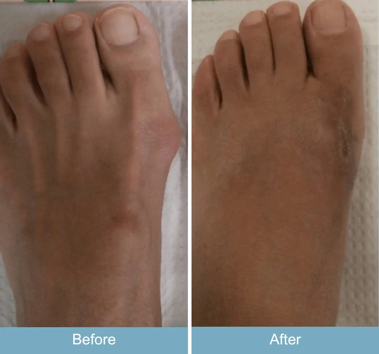 Before and after comparison of foot showing reduced bunion prominence and swelling