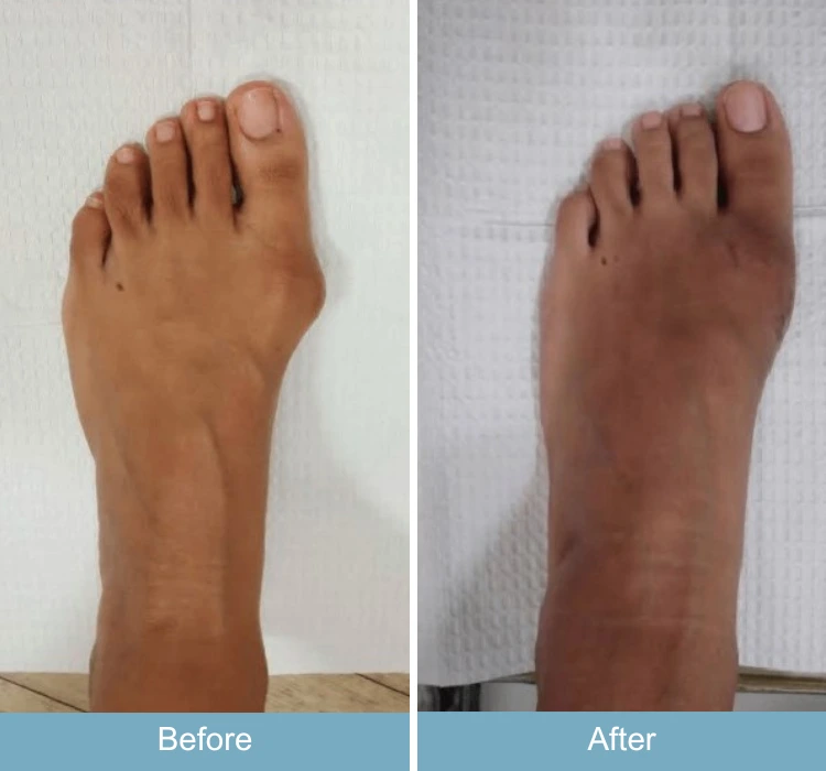 Before and after comparison of foot showing reduced bunion deformity and swelling