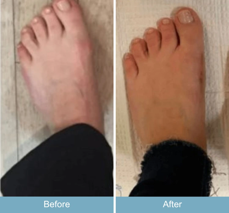 Before and after comparison of swollen foot showing reduced inflammation and normal coloring