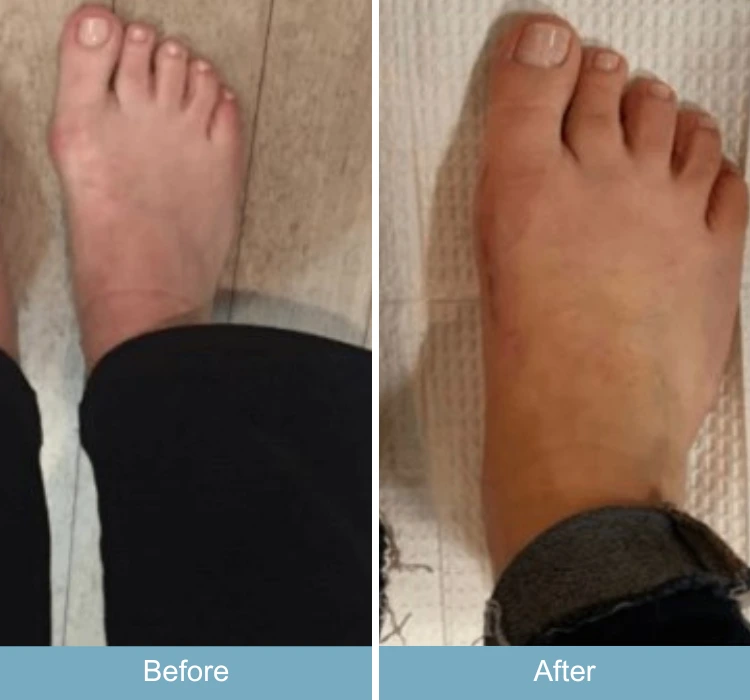 Before and after comparison of swollen foot showing reduced inflammation and improved shape