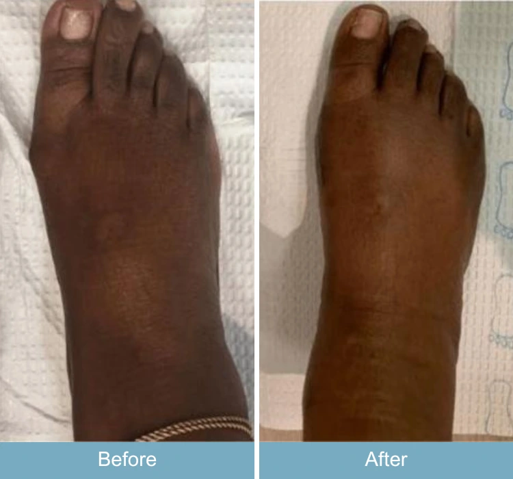 Before and after foot showing reduced swelling and improved appearance