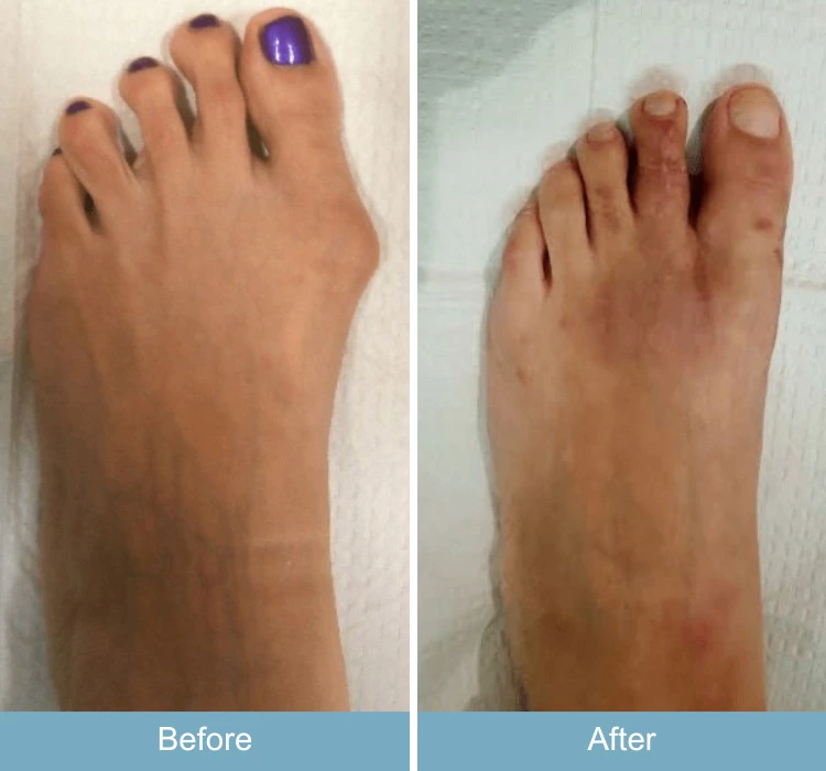 Before and after comparison of foot showing reduced swelling and improved alignment