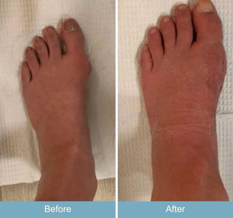 Before and after foot showing reduced swelling and improved shape