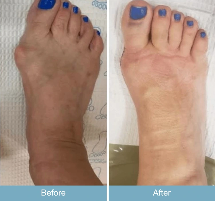 Before and after foot showing reduced swelling and improved appearance
