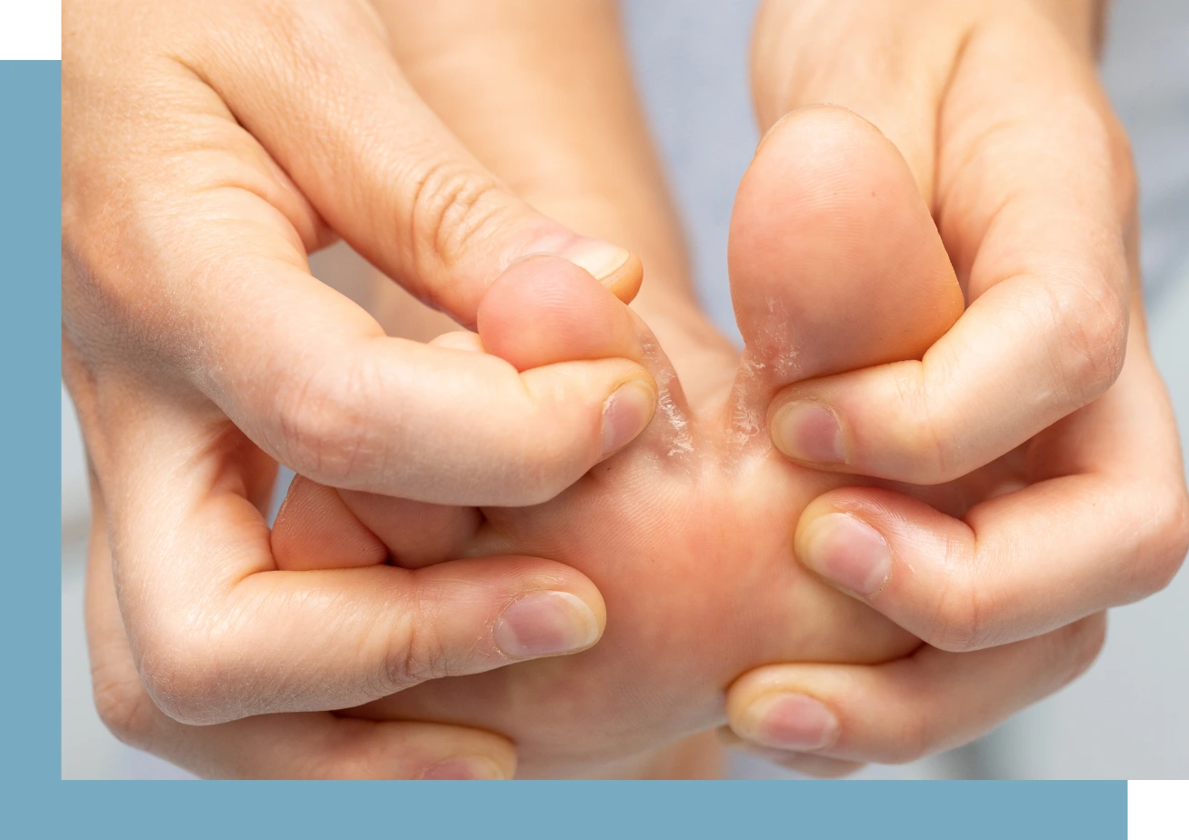 Arthritic Foot