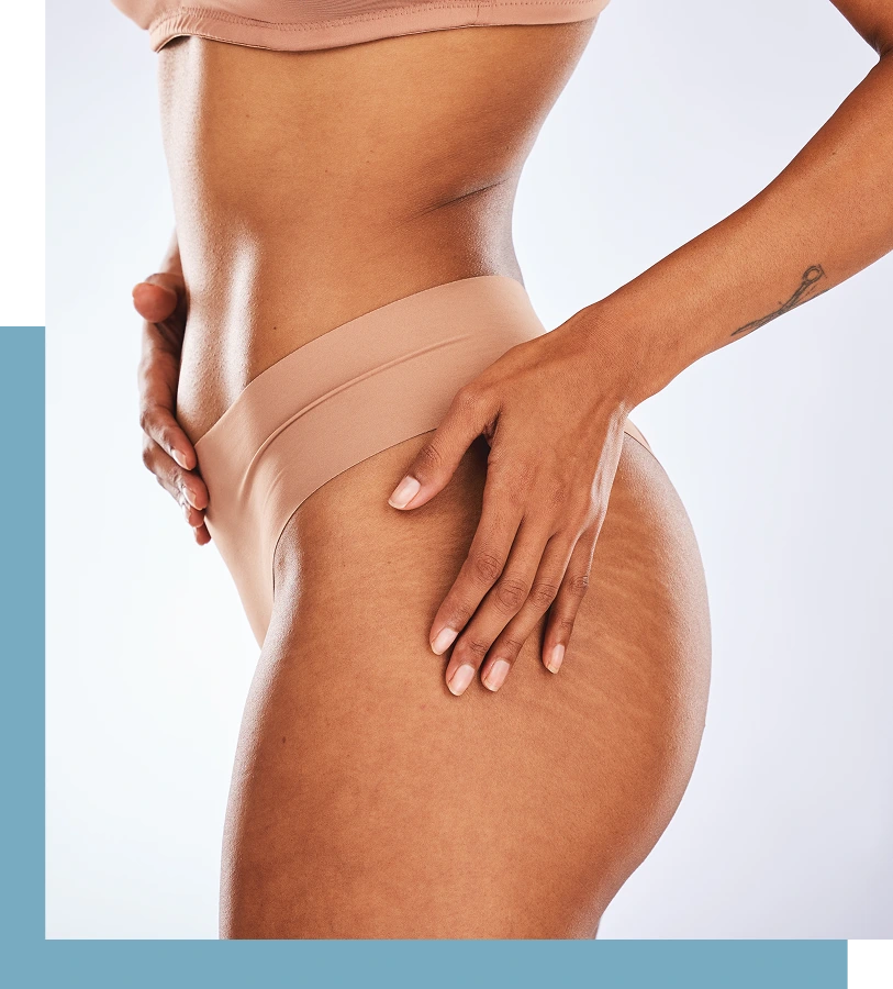 Stretch Mark Reduction in New York City Banner