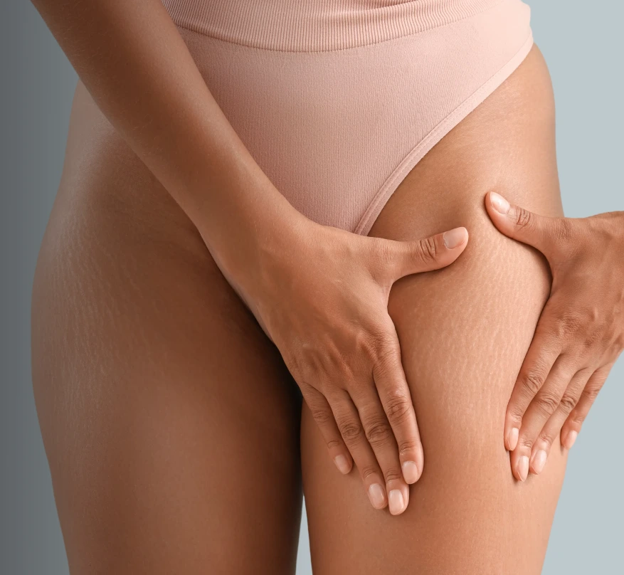 Stretch Mark Reduction in NYC Banner