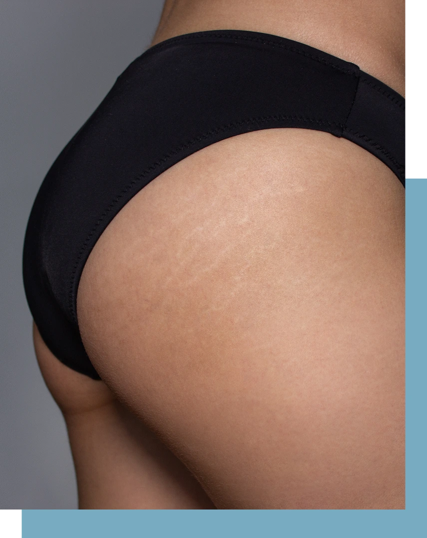 Stretch Mark Treatment in NYC Banner