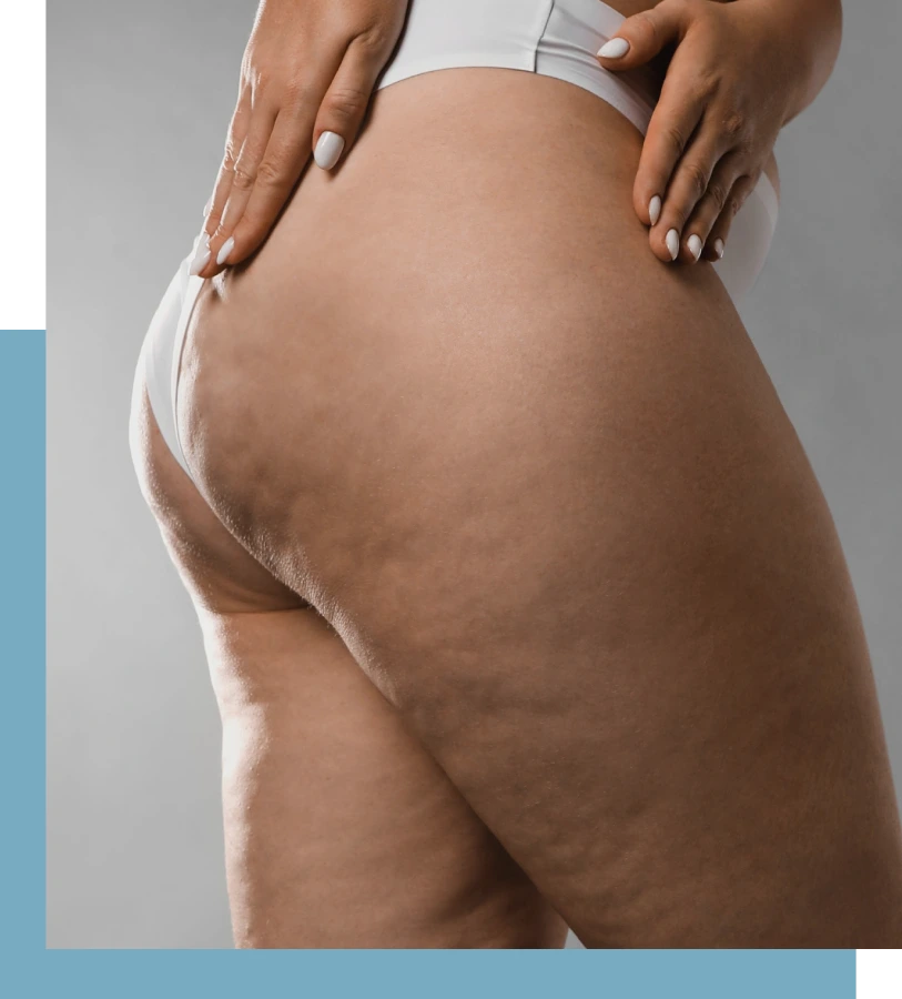 Cellulite Therapy in NYC Banner