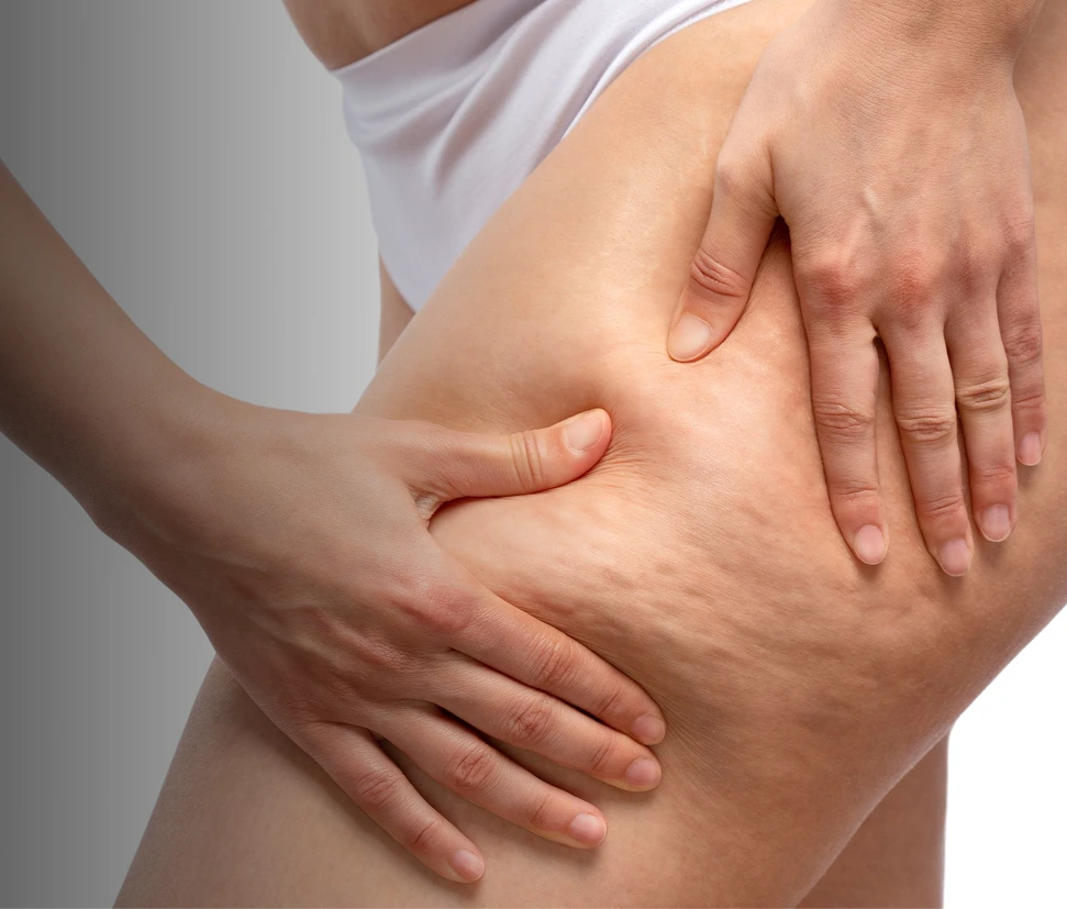 Cellulite Treatment in NYC Banner