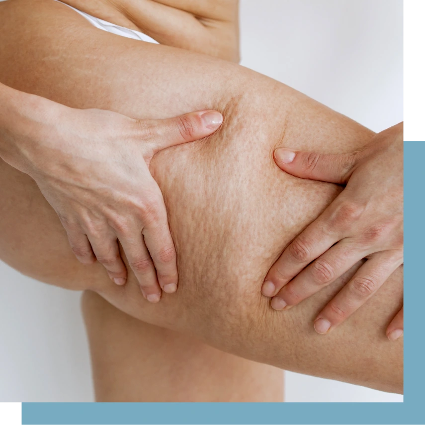 Cellulite Treatment NYC Banner
