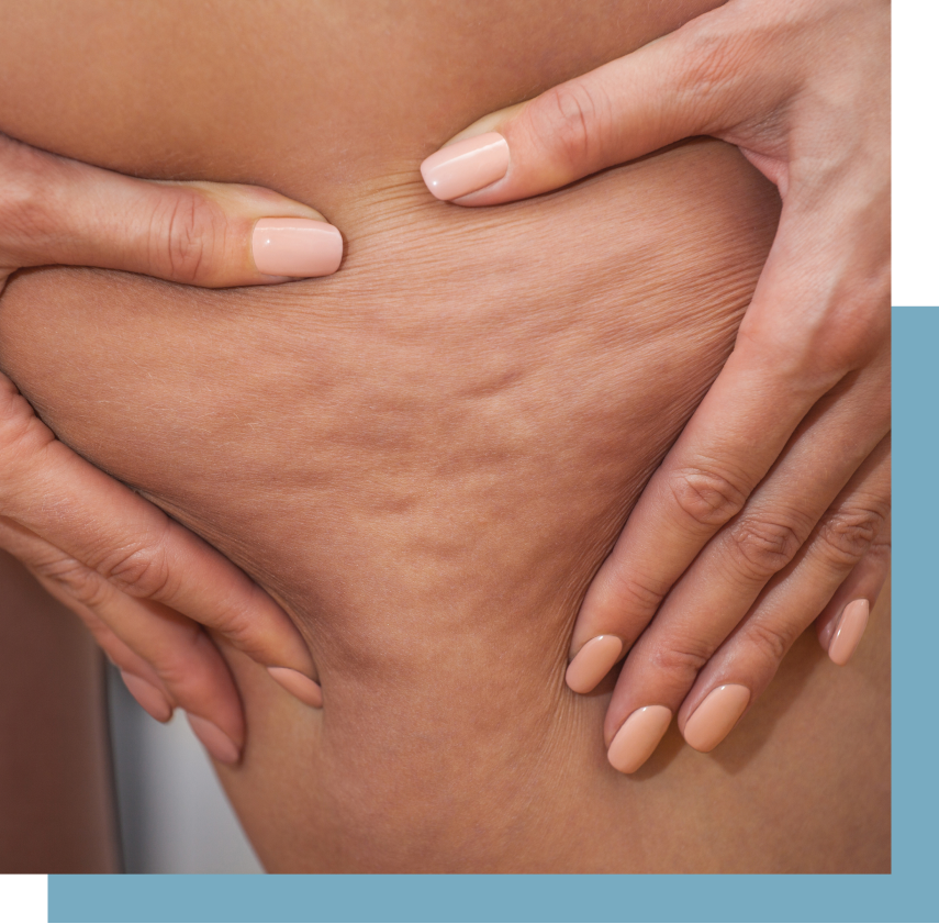 NYC Cellulite Treatment Options Banner