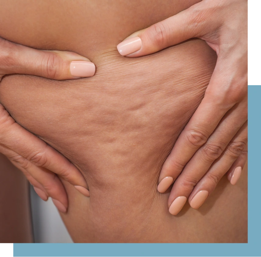 NYC Cellulite Treatment Options Banner