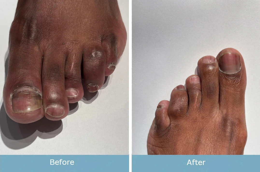 Before and after toenail treatment showing improved nail appearance and reduced discoloration
