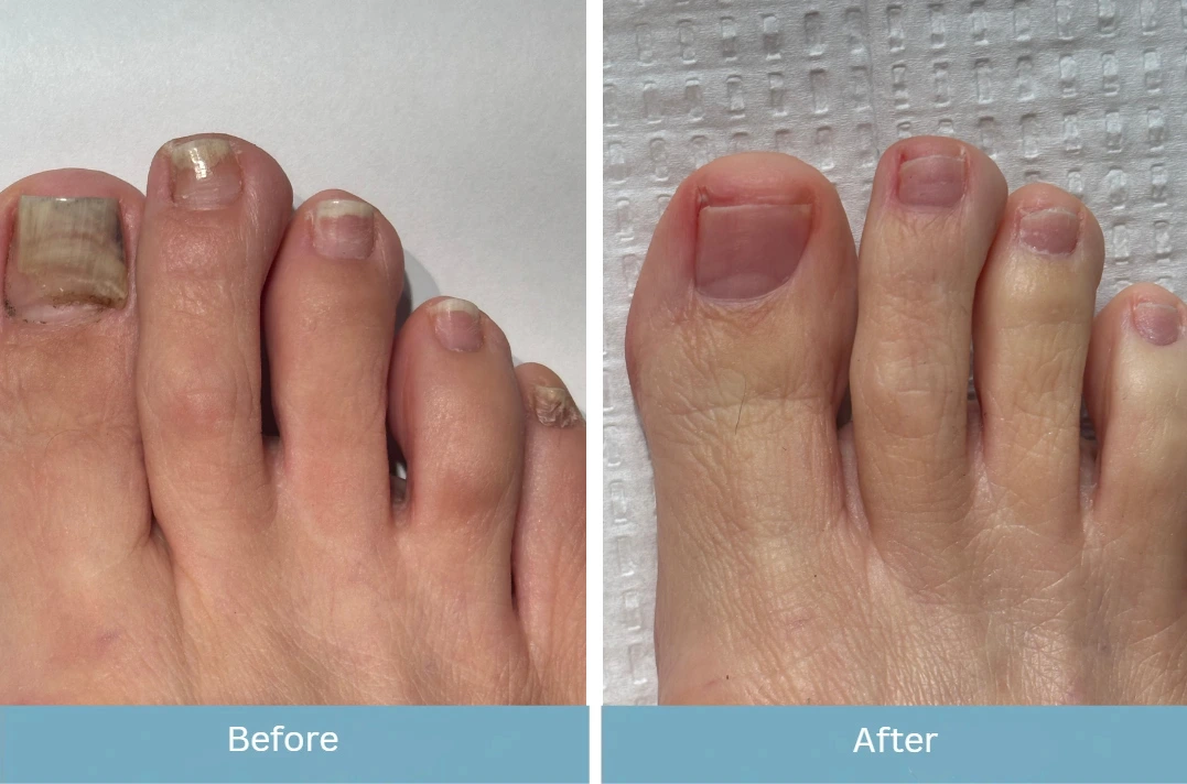 Before and after foot treatment showing healthier nail texture and appearance