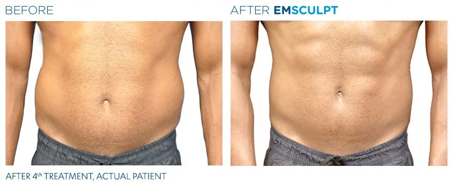Emsculpt-before-and-after-man-1