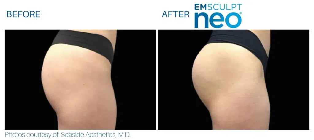 emsculpt_neo_before_and_after_pics_juliaedelmanmd_9-1024x459.jpg