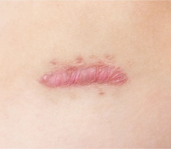 What Are Keloids