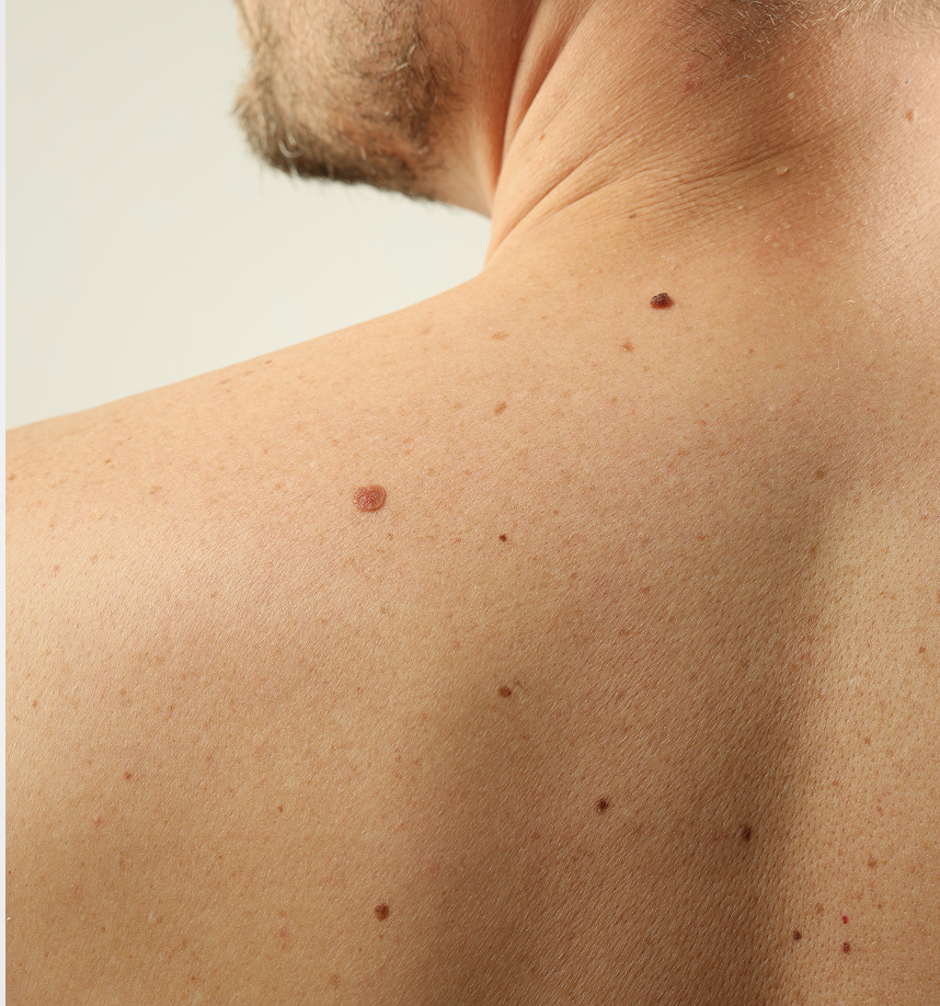 Dermatology Skin Biopsy in Fresno, CA Banner