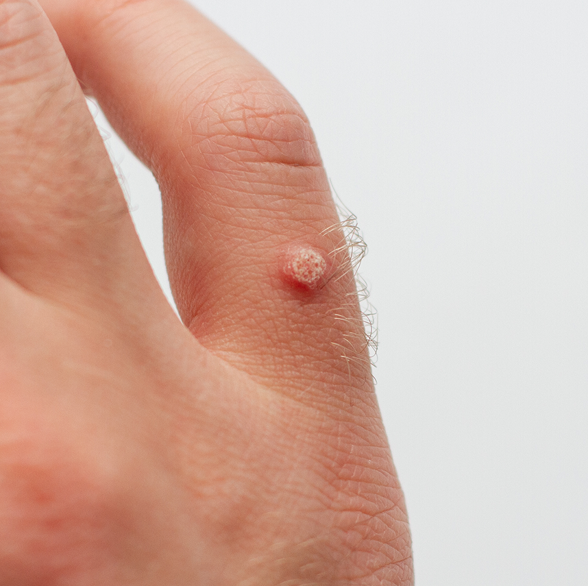 Professional Wart Removal in Fresno, CA Banner