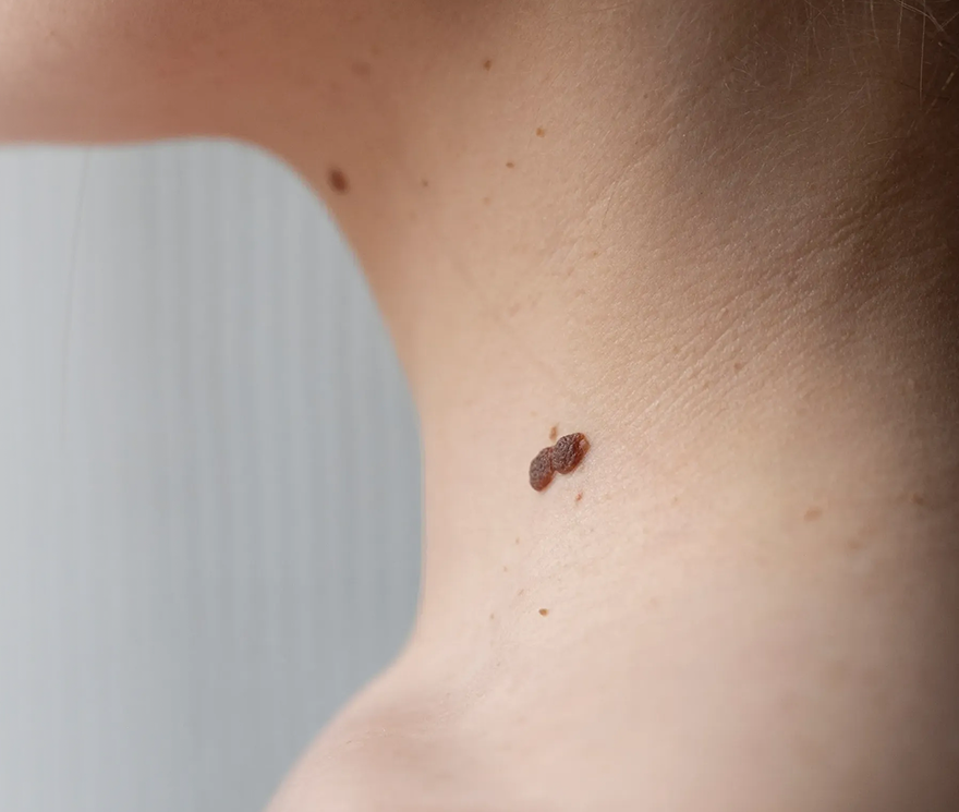 Wart Removal in Fresno, CA Banner