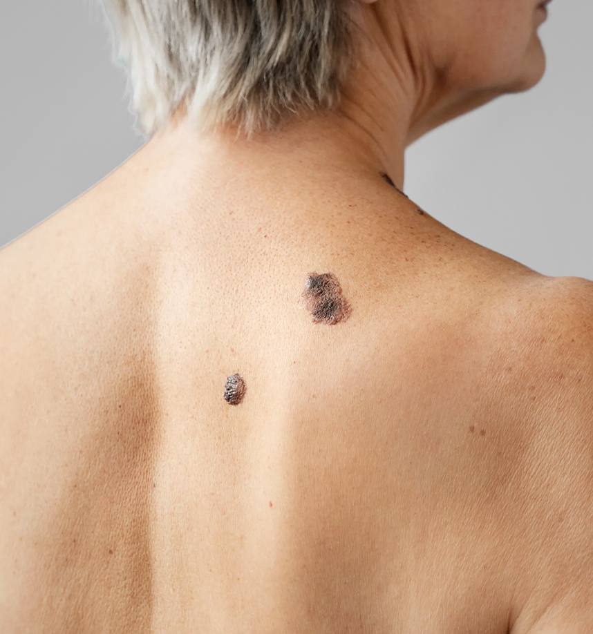 Wart Removal Services in Fresno, CA Banner