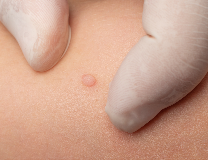 Wart Treatment in Fresno, CA Banner