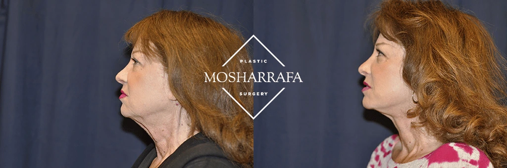 Profile and three-quarter views of a patient showing facial contours before and after facelift surgery