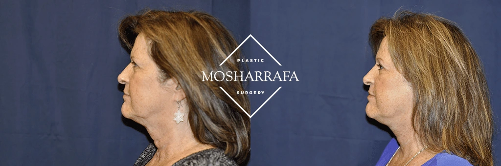 Profile views of a patient demonstrating before and after results of facelift and neck contouring surgery