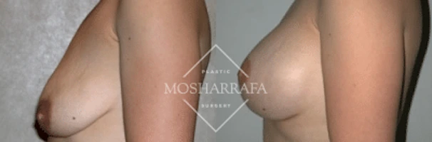 Side profile before and after surgical results showing aesthetic breast enhancement