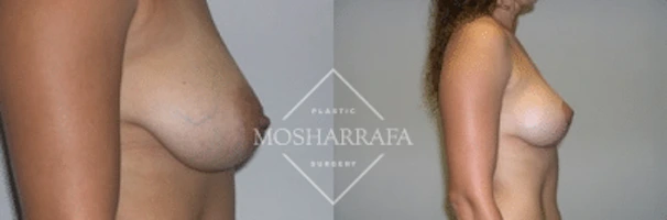 Before and after breast augmentation, front and side view