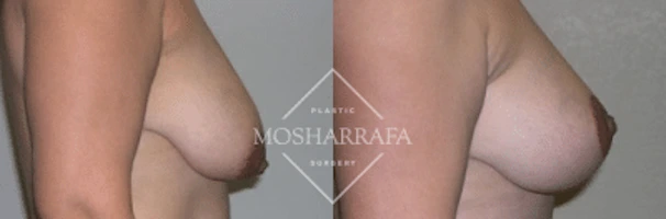 Before and after front view comparison of breast augmentation results