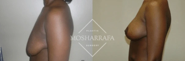 Before and after side profile comparison of breast augmentation results
