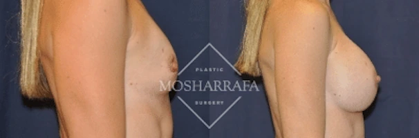 Before and after breast augmentation, side view