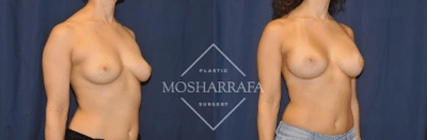 Before and after breast augmentation surgery, frontal view