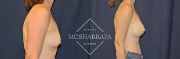 Before and after breast augmentation surgery, side view