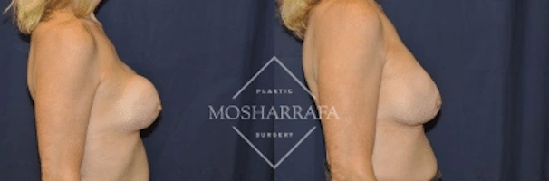 Before and after side view of breast augmentation results