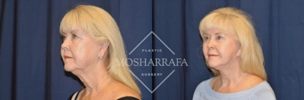 Woman's profile before-and-after facial appearance comparison