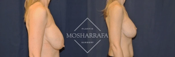 Breast augmentation before and after, side view comparison