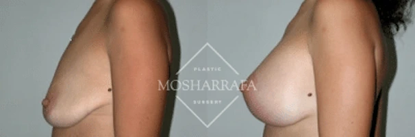 Before and after breast surgery results, side view
