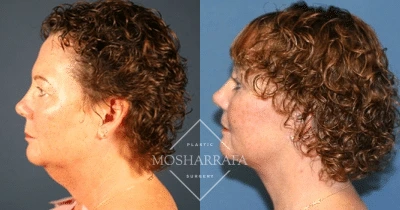 Person's profile before-and-after facial appearance comparison