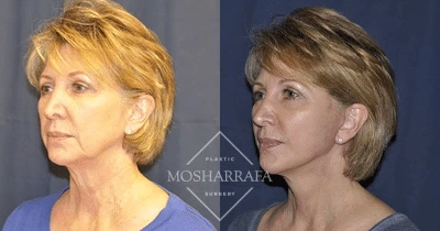 Before and after profile comparison showing facial structure and skin appearance changes