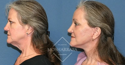 Before and after side profile views of a patient showing neck and jawline improvement