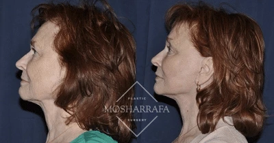 Before and after side profile views of a patient showing facial contour enhancement