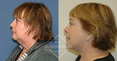 Before and after profile view of female patient showing facial refinement